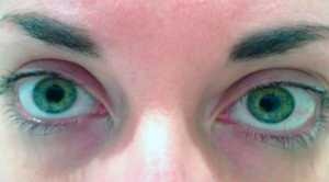 фото глаз при употреблении наркотика винт (метамфетамин)